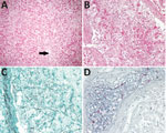 Invasive fungal infection in transplanted liver from an organ donor who drowned, United States (case 2). A) Centrilobular hepatic necrosis without substantial inflammation; fungal hyphae are in a central vein (arrow) and throughout the sinusoids. Hematoxylin–eosin; original magnification ×100. B) Numerous fungal hyphae are in the lumen and wall of a large hepatic vessel. Hematoxylin–eosin; original magnification ×200. C) Grocott methenamine silver stain highlights ribbon-like, pauciseptate, branching funal hyphae within the hepatic vessel. Original magnification ×200. D) Intravascular fungal hyphae stain red by immunohistochemical assay for mucormycete fungi. Original magnification ×200.