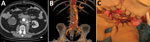 Vascular prosthetic mucormycosis in a 57-year-old immunocompetent patient in France. A, B) Aortic computed-tomography angiogram (A) and 3-dimensional reconstruction (B) show the periprosthetic collection and vascular leak (arrows). C) Intraoperative view shows the graft exposure and false necrotic membranes.