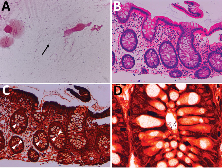 Microscopic findings in ileocolonic biopsy specimens (second colonoscopy) in a man in Japan who had recurrent Helicobacter fennelliae bacteremia. A) Morphologic features of the bacteria in a cecal tissue suspension with Gram staining (original magnification ×2,000). Arrow indicates gram-negative spiral bacilli. B) Histologic findings in a biopsy specimen taken from the transverse colon with hematoxylin-eosin staining (original magnification ×200). The colonic mucosa shows mild leukocytic infiltration. C) Histologic findings in a biopsy specimen taken from the transverse colon with Warthin-Starry silver staining (original magnification ×200). Bacteria are aggregated in crypts (arrowheads) D) Morphologic features of bacteria obtained from the transverse colon with Warthin-Starry silver staining (original magnification ×1,000). A cluster of spiral bacilli was observed.