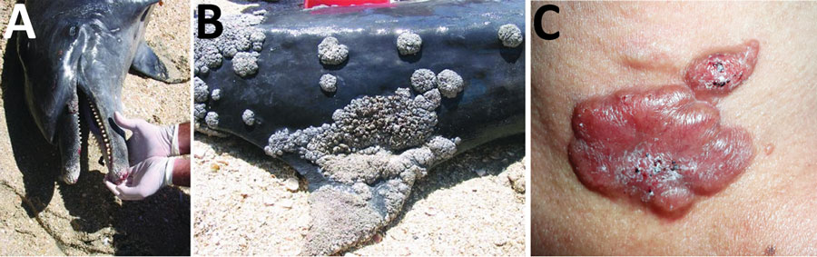 A, B) Extensive lobomycosis-like disease on the beak and dorsal fin of a bottlenose dolphin (Tursiops truncatus) stranded on Margarita Island, Venezuela. Source: Emerging Infectious Diseases 15 (8), August 2009. C) Lobomycosis in a 41-year-old soldier from Colombia. Erythematous, lobulated plaque (4 cm × 2.5 cm) on the sternal notch with hematic crust and black areas on the surface. Source: Emerging Infectious Diseases 25 (4), April 2019.