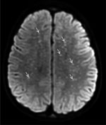 Diffusion-weight magnetic resonance imaging of the brain of a previously healthy 5-year-old boy from Tecate, Mexico, who had Rocky Mountain spotted fever and was treated at Rady Children’s Hospital, San Diego, California, USA. The “starry sky” appearance shows numerous punctate foci of cytotoxic edema involving the supratentorial white matter (arrows), in keeping with acute to subacute injury from small vessel vasculitis.