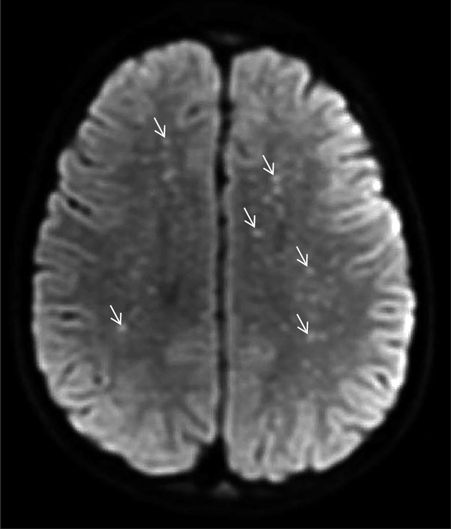 Diffusion-weight magnetic resonance imaging of the brain of a previously healthy 5-year-old boy from Tecate, Mexico, who had Rocky Mountain spotted fever and was treated at Rady Children’s Hospital, San Diego, California, USA. The “starry sky” appearance shows numerous punctate foci of cytotoxic edema involving the supratentorial white matter (arrows), in keeping with acute to subacute injury from small vessel vasculitis.