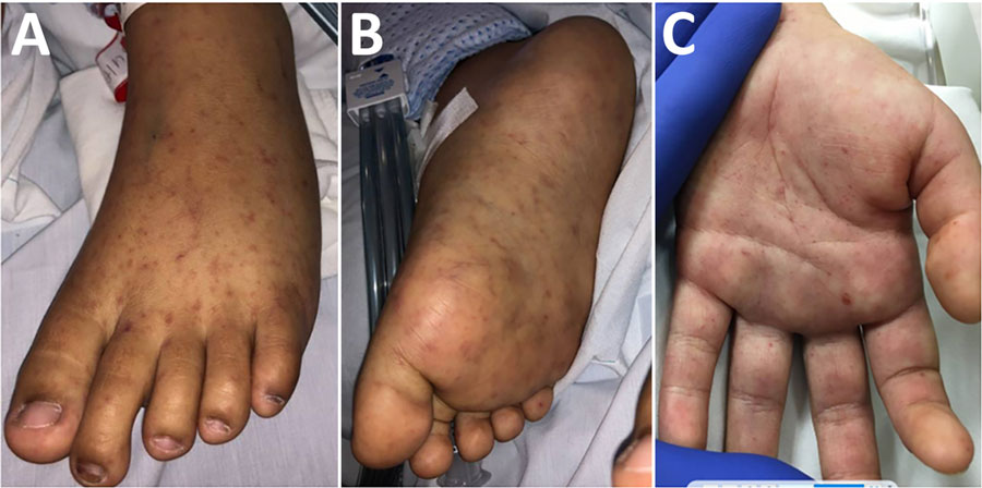 Characteristic petechial rash on the palms and soles of children with Rocky Mountain spotted fever treated at Rady Children’s Hospital, San Diego, California, USA.