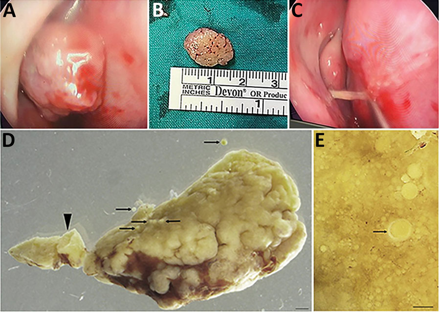 Macromorphology of excised recurrent nasal polyp from a 24-year-old Black woman with rhinosporidiosis, South Africa. A) Intraoperative endoscopic image of mass in right nasal cavity. B) Polypoid, oval mass measuring 15 mm. C) Stalk that attached the mass to the nasal septum. D) Portion of the pedunculated polyp (arrowhead) dotted with developing and mature sporangia (arrows). Scale bar = 1 mm. E) Surface of tissue with multiple sporangia in various stages of maturity, with the chitinous wall thickening during maturation (arrow). Scale bar = 150 μm.