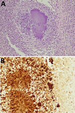 Immunology of mass in a case of fatal renal abscess caused by Porphyromonas gingivalis and subcapsular hemorrhage, Japan. A) Hematoxylin and eosin stain. Original magnification ×100. B) Immunohistochemistry with antibody diluted 100 times. Original magnification ×200.