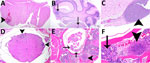 Histopathologic analyses of the neurologic system of C57BL/6 mice after inhalation of Burkholderia pseudomallei strain ATS2021, the causative strain in an an outbreak of 4 cases, 2 of them fatal, in the United States in 2021. A) Day 5 after exposure of group 4 mouse 45, dose 1,150 CFU. Cerebrum showing focally extensive necrotizing and hemorrhagic meningoencephalitis (arrowhead). Hematoxylin and eosin (HE) stain; original magnification ×2. B) Day 9 after exposure, dose 107 CFU. Pons and cerebellum. There is multifocal necrotizing meningoencephalitis (arrows). HE stain; original magnification ×2. C) Day 10 after exposure, dose 1,150 CFU. Cerebrum with olfactory peduncle filled with viable and degenerate neutrophils with no recognizable peduncular tissue (arrowhead). HE stain; original magnification ×20. D) Day 9 after exposure, 107 CFU. Spinal cord, thoracic, shows multifocal meningomyelitis (arrowheads). HE stain; original magnification ×4. E) Day 5 after exposure, 1,150 CFU. Spinal cord and vertebrae, lumbar at cauda equina, show is multifocal suppurative perineuritis of spinal nerves (arrows). Note the necrotizing lesion within the vertebral bone marrow (arrowhead) HE stain; original magnification ×10. F) Day 4 after exposure, dose 1,150 CFU. Spinal cord and vertebra, thoracic, show necrotizing osteomyelitis (arrowhead). Note the loss of distinction of bone marrow cells compared to normal cells of the bone marrow (arrow). HE stain; original magnification ×40.