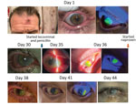 Physical and ophthalmologic examination results over time of a 46-year-old patient in St. Louis, Missouri, USA, after receiving mpox and HIV diagnoses. The exam remained unchanged after day 44 despite treatment. IV, intravenous. 