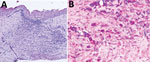 Right eye cornea histopathology from a 46-year-old patient in St. Louis, Missouri, USA, with ocular mpox diagnosis. Sample was collected on day 217 after the patient initially sought care. A) Corneal epithelium is intact. Stromal lesion shows focal scarring with inflammation composed of lymphocytes, plasma cells, and rare neutrophils. B) Orthopoxvirus antigens detected by immunohistochemistry in area of stromal lesion.