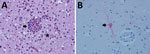 Histologic analysis of brain tissue from a dead free-ranging polar bear infected with highly pathogenic avian influenza virus A(H5N1) clade 2.3.4.4b, Alaska, USA. A) Hematoxylin and eosin staining of brain tissue section showing meningoencephalitis. Arrow indicates mixed inflammatory cells within and around blood vessels and hypertrophied vascular endothelial cells. Star indicates necrotic neurons and increased number of microglial cells within the parenchyma. Original magnification ×400. B) Arrow indicates influenza A virus within the neuronal perikaryon (red staining) observed by immunohistochemistry of formalin-fixed paraffin-embedded brain sections. Original magnification ×400.