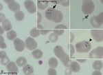 Peripheral blood smear from patient who had a confirmed case of autochthonous human babesiosis, Hungary. Smear shows erythrocytes infected with Babesia sp.; smear was stained with May-Grünwald Giemsa stain and examined by using light microscopy. In inset images, solid arrow indicates cells infected with multiple merozoites, open arrow indicates extracellular parasites, and arrowhead indicates vacuolated ring forms (trophozoites). Scale bars indicates 10 μm.