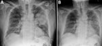 Chest radiographs of patient with Pantoea stewartii subspecies indologenes infection, Queensland, Australia. A) Radiograph at time of initial emergency department visit, showing dense left upper lobe consolidation consistent with pneumonia. B) Repeat radiograph on day 12 of hospital admission, showing resolving left upper and middle zone opacification.