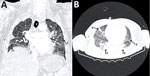 Computed tomography with contrast of the chest of a patient from Brazil infected with Burkholderia mallei. A) Coronal section, showing a heterogeneous pattern of lung attenuation. Arrows marked 1 indicate a suggestive disturbance in the ventilation-perfusion relationship. B) Axial section. Arrow marked 2 indicates consolidative opacities. Arrows marked 3 indicate subsegmental atelectasis in both lungs.