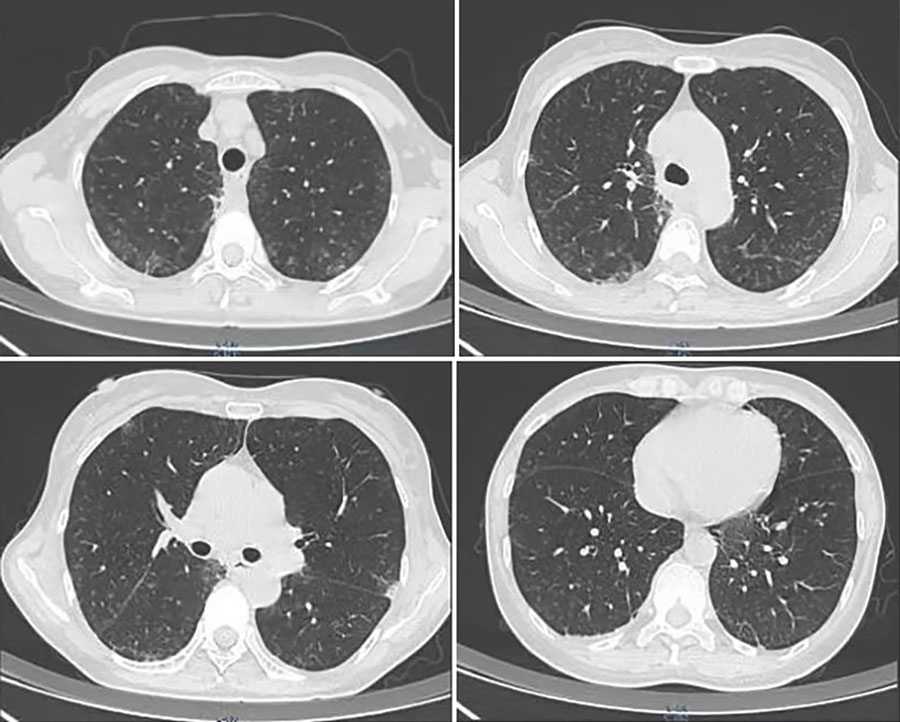 Chest computed tomography scans of immunocompetent patient in China who was co-infected with COVID-19 and non-HIV severe Pneumocystis jirovecii pneumonia, performed on June 22, 2023. Images show bronchial vascular bundles blurred in bilateral lungs with multiple tree-in-bud signs, multiple ground-glass shadows, and bilateral subpleural consolidation.