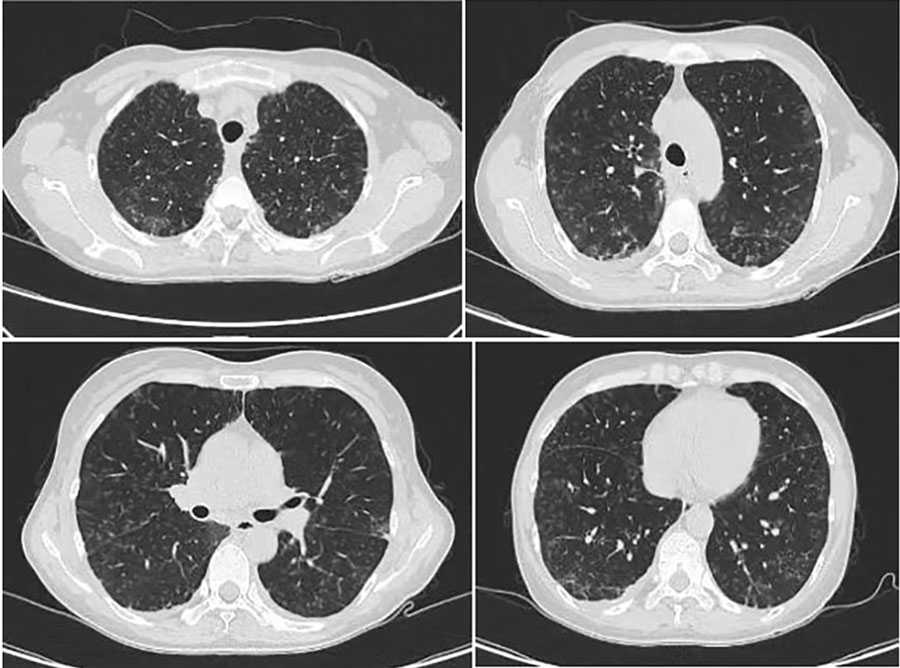 Chest computed tomography scans of immunocompetent patient in China who was co-infected with COVID-19 and non-HIV severe Pneumocystis jirovecii pneumonia, performed on June 25, 2023. Images show multiple tree-in-bud signs, ground-glass shadows, and substantially increased bilateral subpleural consolidation in the lungs.