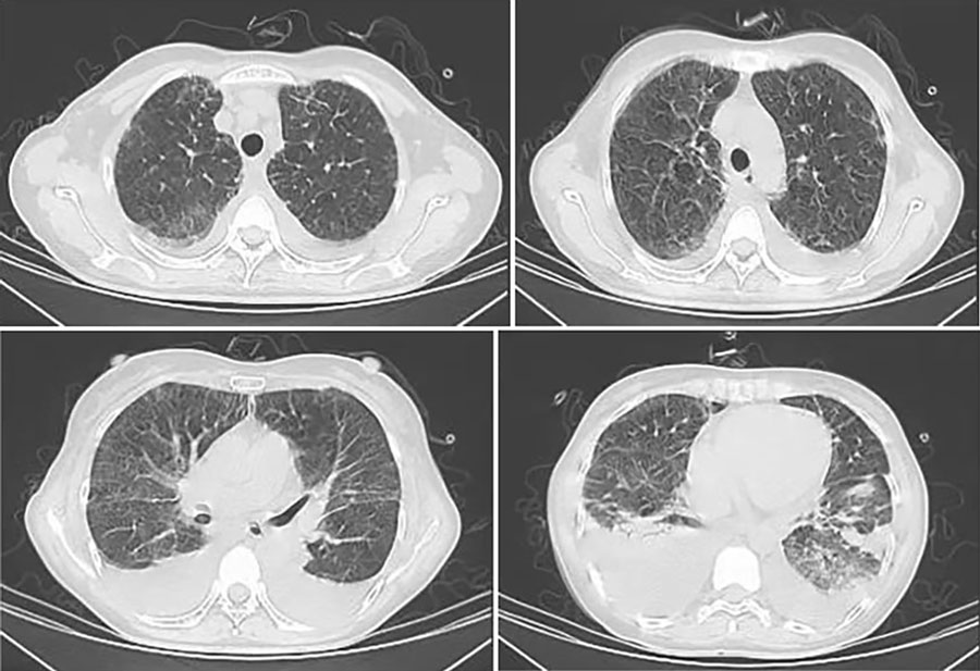 Chest computed tomography scans of immunocompetent patient in China who was co-infected with COVID-19 and non-HIV severe Pneumocystis jirovecii pneumonia, performed on June 30, 2023. Images show blurred bronchovascular bundles, interlobular thickening, and subpleural small-band of ground-glass changes in bilateral lungs, with increased bilateral pleural effusion.