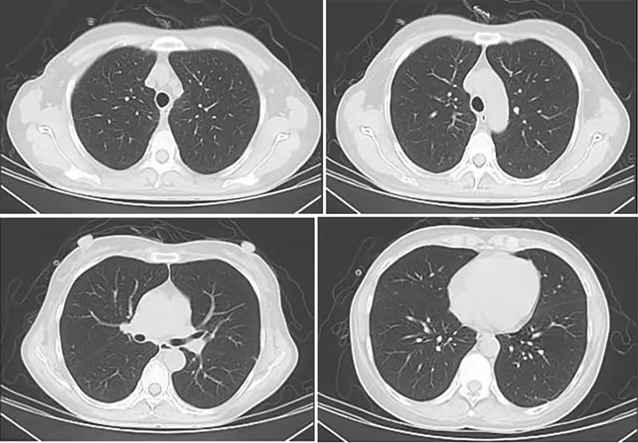 Chest computed tomography scans of immunocompetent patient in China who was co-infected with COVID-19 and non-HIV severe Pneumocystis jirovecii pneumonia, performed on July 17, 2023. All lung lesions were absorbed bilaterally.