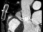 Preoperative contrast-enhanced computed tomography (sagittal) of an 81-year-old male patient in Germany who had Pasteurella dagmatis infection after a domestic cat bite, indicating a paravalvular abscess of 24 × 14 × 31 mm. The large abscess near his mechanical valve, combined with P. dagmatis bacteria in blood cultures, confirmed a diagnosis of infective endocarditis based on Duke criteria (7).