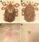 Biting Amblyomma maculatum tick removed from a woman in Connecticut, USA, and signs of Rickettsia parkeri spotted fever. A, B) Dorsal (A) and ventral (B) images of the tick. C, D) A small, erythematous, crusted lesion with a smaller satellite papule that developed at the bite site (C) and 1 of several small erythematous macules that developed on her arm and legs (D).