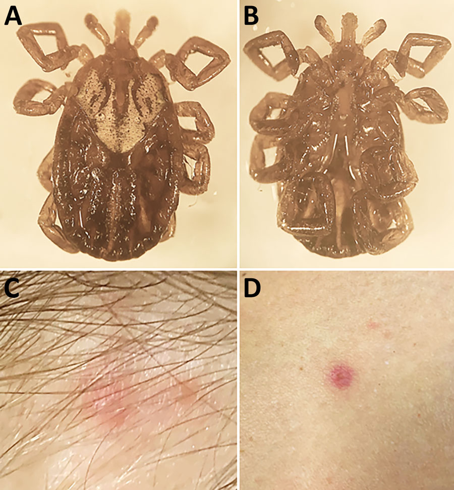 Biting Amblyomma maculatum tick removed from a woman in Connecticut, USA, and signs of Rickettsia parkeri rickettsiosis. A, B) Dorsal (A) and ventral (B) images of the tick. C, D) A small, erythematous, crusted lesion with a smaller satellite papule that developed at the bite site (C) and 1 of several small erythematous macules that developed on her arm and legs (D).