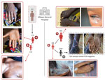 Clinical manifestations of suspected mpox from 2 mother-child pairs in study of presumed transmission of monkeypox virus variants from Central African Republic to Democratic Republic of the Congo. One mother-child pair was linked to the deceased fisherman in Mbaya Health Zone, and the other pair were identified at Mbaya Hospital, Mbaya, Democratic Republic of the Congo. Created with BioRender.com.