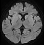 Diffusion weighted magnetic resonance imaging scan of brain in study of acute encephalopathy associated with human adenovirus type 14 infection in 7-year-old girl, Japan. Image shows high intensity in the subcortical white matter and bilateral caudate nuclei.