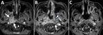 Chronological changes in lesions observed on contrast-enhanced fat-suppressed T1-weighted magnetic resonance imaging at the nasopharyngeal level in a patient in Japan with invasive chronic rhinosinusitis caused by Bjerkandera adusta fungi. A) Initial visit. Enhancement effects observed in the right nasopharynx, including the right torus tubarius and right prevertebral space (white arrows). B) Three months after the initial visit. Expansion of the enhancing lesion is seen, with enhancement extending to the left peritubal region (white arrowhead) and prevertebral space (white arrow). C) One year after the initial visit. The abnormal enhancement previously observed around both the torus tubarius and prevertebral space has regressed.