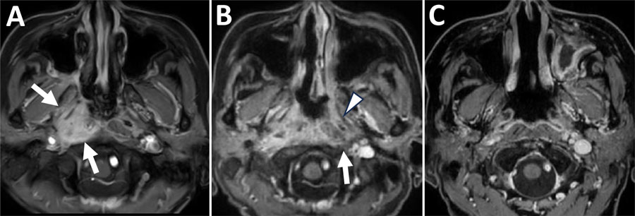 Chronological changes in lesions observed on contrast-enhanced fat-suppressed T1-weighted magnetic resonance imaging at the nasopharyngeal level in a patient in Japan with invasive chronic rhinosinusitis caused by Bjerkandera adusta fungi. A) Initial visit. Enhancement effects observed in the right nasopharynx, including the right torus tubarius and right prevertebral space (white arrows). B) Three months after the initial visit. Expansion of the enhancing lesion is seen, with enhancement extending to the left peritubal region (white arrowhead) and prevertebral space (white arrow). C) One year after the initial visit. The abnormal enhancement previously observed around both the torus tubarius and prevertebral space has regressed.