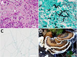 Imaging from a biopsy specimen from a sinus lesion in a patient in Japan with invasive chronic rhinosinusitis caused by Bjerkandera adusta fungi and a Bjerkandera spp. mushroom found in nature. A) Mycelium of filamentous fungi (arrowhead) shown by hematoxylin-eosin staining. Scale bar indicates 20 μm. B) Filamentus fungi shown by Grocott staining. Scale bar indicates 20 μm. C) Mycelium of fungi grown on potato dextrose agar. Scale bar indicates 100 μm. D) Bjerkandera spp., a burnt-looking stemless mushroom that grows in forests. Photograph courtesy of the Tokyo Mushroom Club.