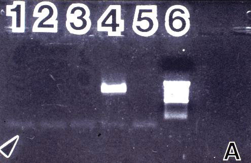 Amplification results of normal and PKD kidney tissue and cyst fluids with universal fungal primers ITS 1 and NL 4. 2A: DNA from healthy human kidney tissue diluted 1:10, 1:100 and 1:1,000 (lanes 1-3); control fungal DNA, A. tamarii (lane 4); negative control (lane 5); 1 kb ladder (lane 6); arrow indicates migration front. 2B (NL 4) and 2C (ITS 1): two cyst fluids, donor 6, negative for detectable endotoxin and ß-DG (lanes 1 and 5); two cyst fluids, donor 4, positive for ß-DG (lanes 2 and 3) and