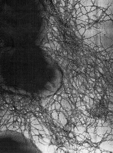 Transmission electron micrograph of Toronto/Edinburgh epidemic clone of B. cepacia expressing CF mucous-binding Cbi adhesin pili. High resolution was achieved by using a JEOL 100CX electron microscope and negative staining. Reprinted with permission from Richard Goldstein and Journal of Bacteriology (J Bacteriol 1995;177:1039-52).