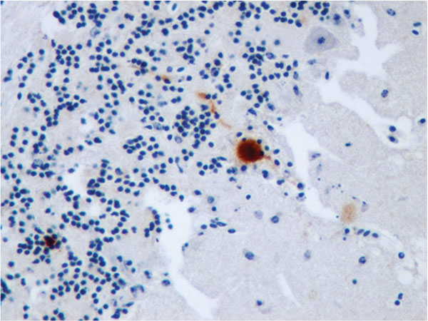 Immunohistochemical staining for Usutu virus antigen in a Purkinje cell of the cerebellum of a song thrush that died of encephalitis. Original magnification ×400.